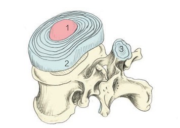 1 3 2 1．髓核 = 果冻状物质2．纤维环 = 纤维软骨环3．脊柱关节突