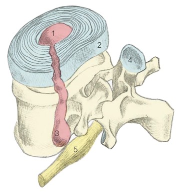 1．髓核2．纤维环3．髓核流向神经（5同3） 4．脊柱关节突1 2 4 3 5