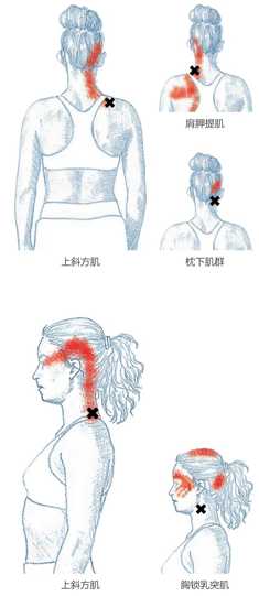 上斜方肌肩胛提肌枕下肌群上斜方肌 胸锁乳突肌